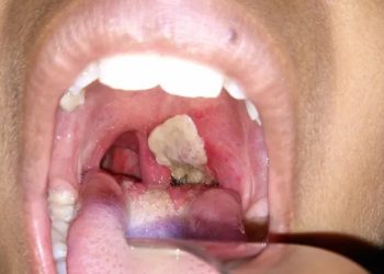 what is the disease diphtheria? learn about the illness that killed five people in odisha, india.concerns have been raised in the