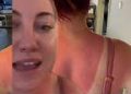 why should you avoid attempting the newest trend that tiktokers are "sunburning" their acne