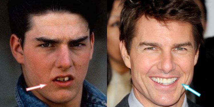 has tom cruise undergone cosmetic procedures to keep his "youthful look"?